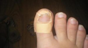 Как применять Ногтимицин от грибка ногтей