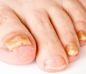 Признаки грибковой инфекции