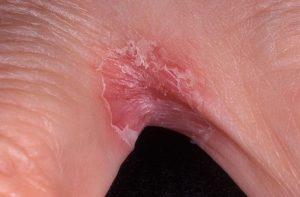 эрозии кожного покрова межпальцевых складок