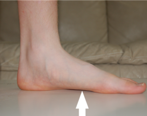 плоскостопие