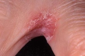 Между пальцами ног чувствуется жжение или зуд