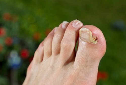 Как проявляется грибок ногтей на ногах