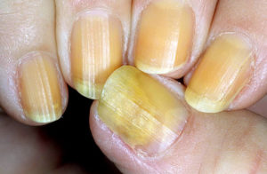 Онихомикоз на конечностях