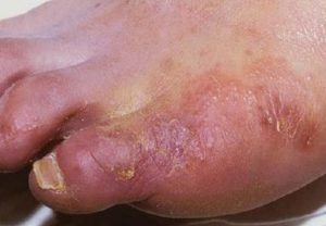 Основные симптомы микозов