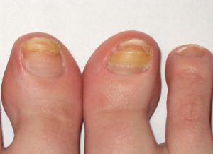 Онихомикоз поражает большие пальцы ног