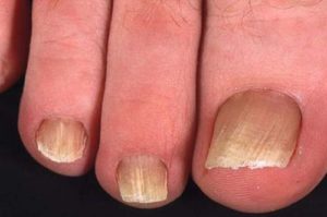 Грибковые споры изначально поражают поверхность ногтевой пластины