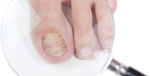 От чего появляется грибок ногтей на ногах