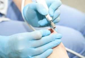 Диагностика грибка ногтей