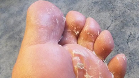 Грибок стопы