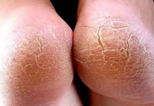 Грибок стопы