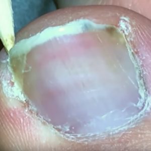 грибок под ногтем