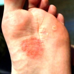 грибок кожи на ногах