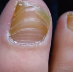 грибок на ногах при диабете