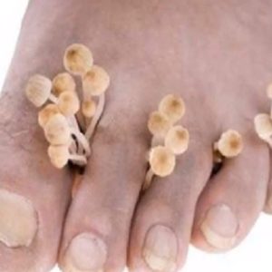 грибок ногтей при беременности